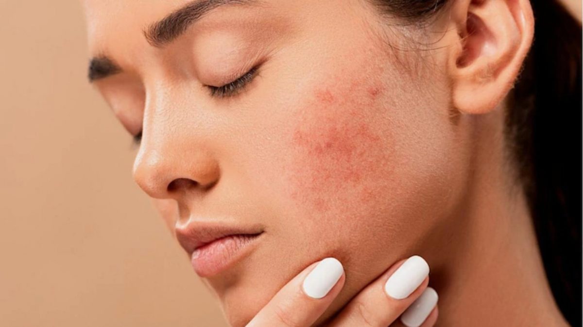 How Can You Avoid Acne By Changing Your Diet?