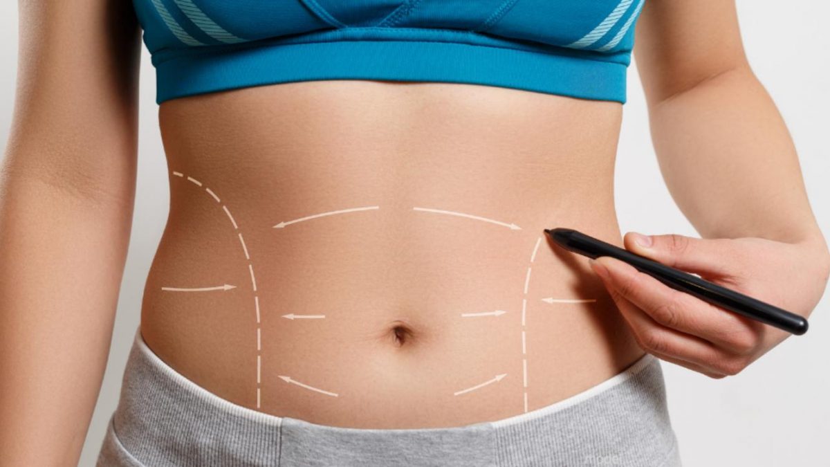 Things to Consider About Before Getting a Tummy Tuck